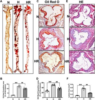 Resveratrol on the Metabolic Reprogramming in Liver: Implications for Advanced Atherosclerosis